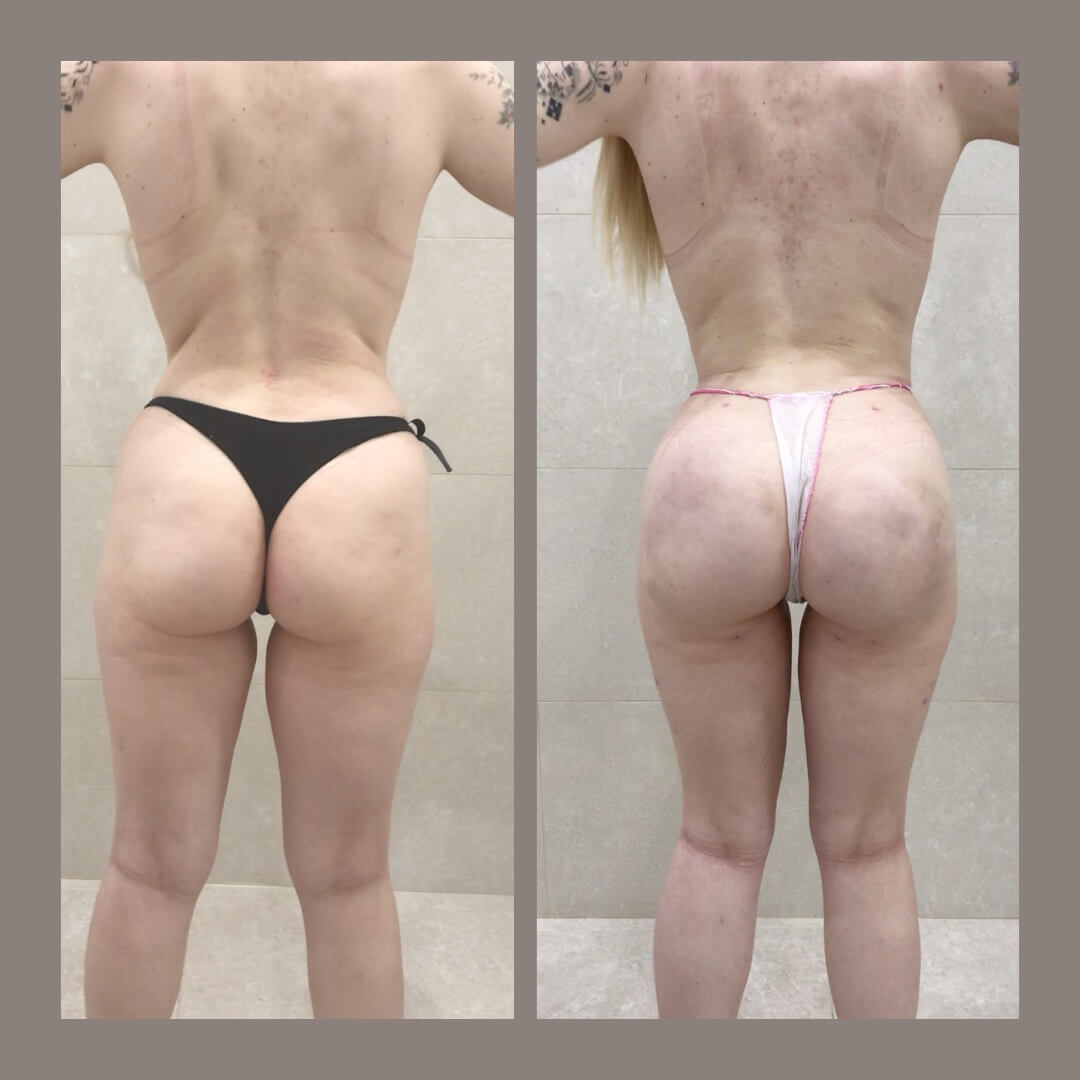 lipofilling de gluteos