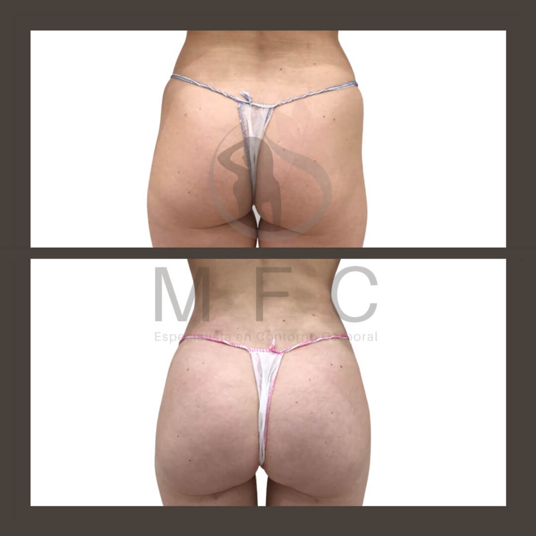 lipofilling de gluteos